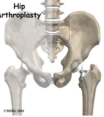 Artificial Joint Replacement of the Hip	