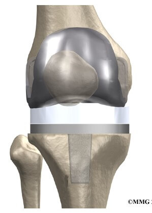 Artificial Joint Replacement	
