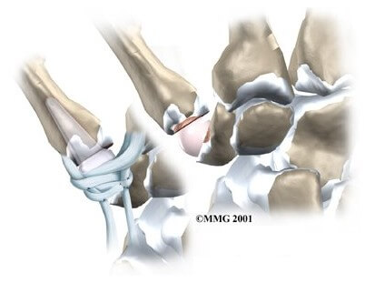 Artificial Joint Replacement of the Thumb	