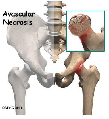 Avascular Necrosis of the Hip	