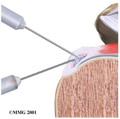 Calcific Tendonitis	