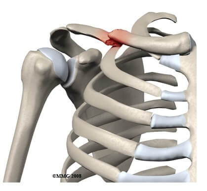 Clavicle Fractures	