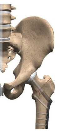 Compression Fixation for Fractured Hip	