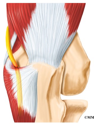 Cubital Tunnel Syndrome	