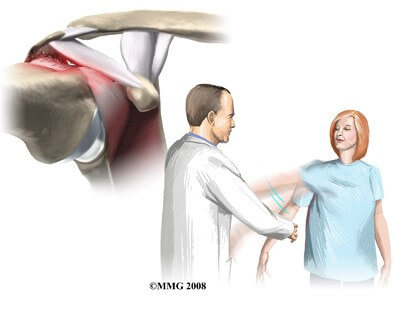 Cuff Tear Arthropathy	