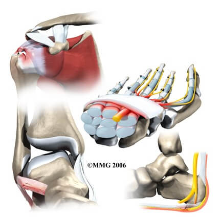 Cumulative Trauma Disorders	