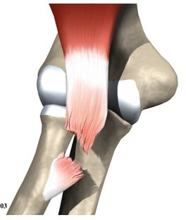 Distal Biceps Rupture	