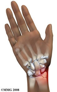 Distal Radius (Wrist) Fractures	