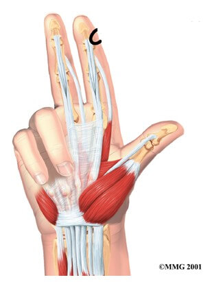 Dupuytren's Contracture	