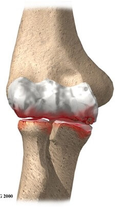 Osteoarthritis of the Elbow	