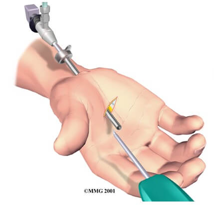 Endoscopic Carpal Tunnel Release	