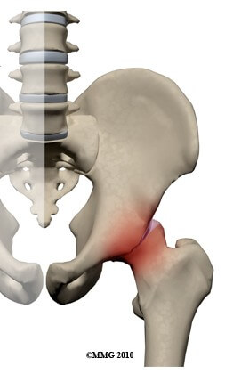 Femoracetabular Impingement	