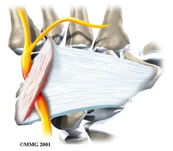 Guyon's Canal Syndrome	