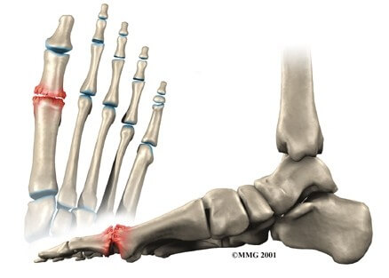 Hallux Rigidus	