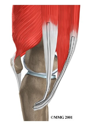 Hamstring Tendon Graft Reconstruction of the ACL	