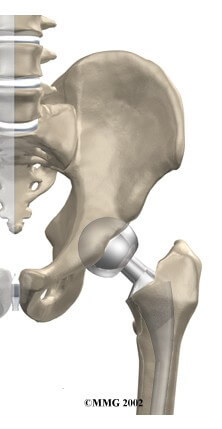 Hemiarthroplasty of the Hip	