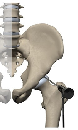 Hip Arthroscopy	