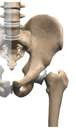 Hip Fractures	