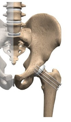 Hip Pinning Surgery	