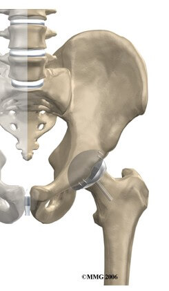 Hip Resurfacing Arthroplasty	