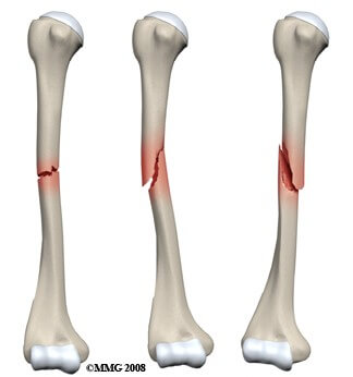 Humerus Shaft Fractures	