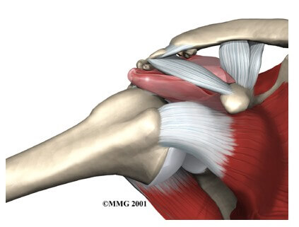 Impingement Syndrome	