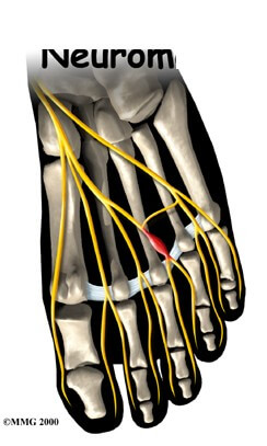 Interdigital Neuroma	