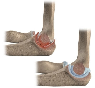 Interposition Arthroplasty of the Elbow	