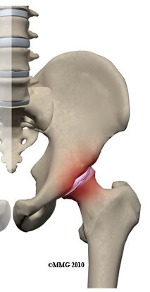 Labral Tears of the Hip	