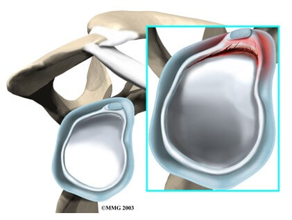 Labral Tears	