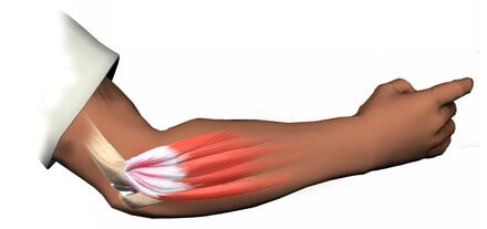 Lateral Epicondylitis	