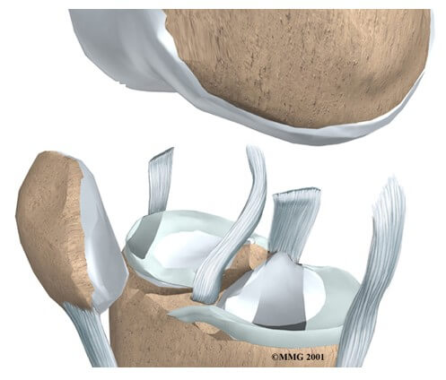 Meniscal Injuries	