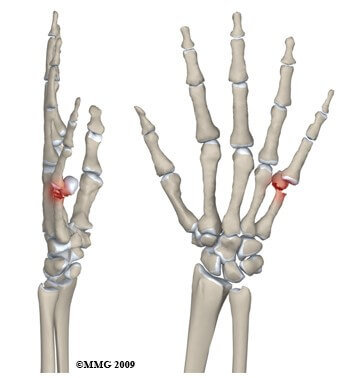 Metacarpal Fractures of the Hand	