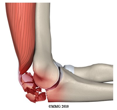 Olecranon (Elbow) Fractures	