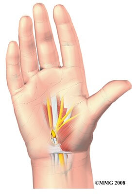 Open Carpal Tunnel Release	