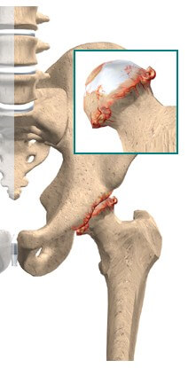 Osteoarthritis of the Hip	