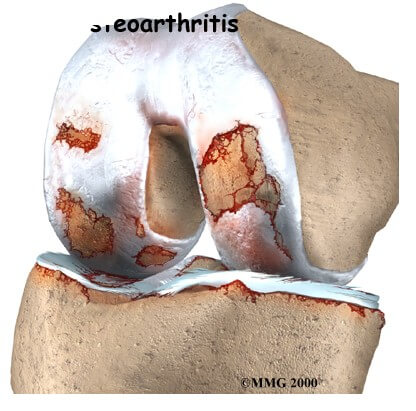 Osteoarthritis