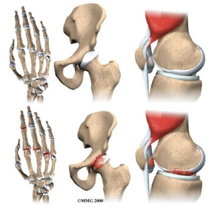 Osteoarthritis