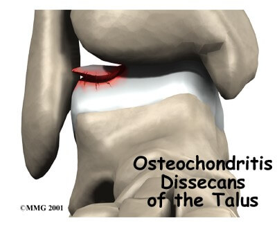 Osteochondritis Dessecans of the Talus	