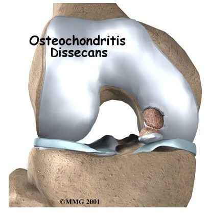 Osteochondritis Dissecans	