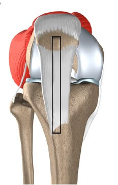 Patellar Tendon Graft Reconstruction of the ACL	