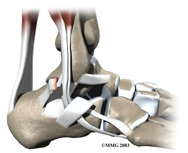 Peroneal Tendon Subluxation	