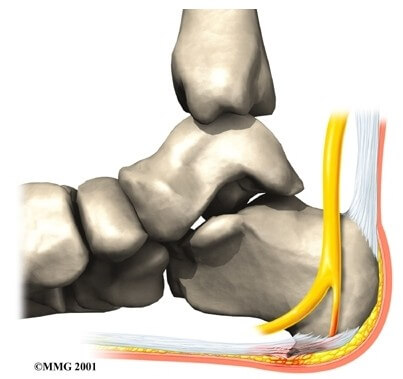 Plantar Fasciitis (Heel Pain)	