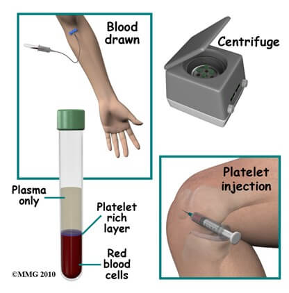 Platelet-Rich Plasma	