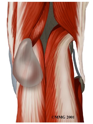 Popliteal Cyst	