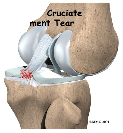 Posterior Cruciate Ligament Injuries	