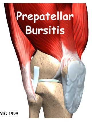 Prepatellar Bursitis	