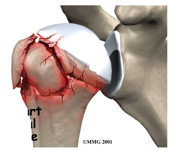 Proximal Humerus(Shoulder) Fractures	