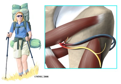 Quadrilateral Space Syndrome	