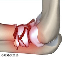 Radial Head (Elbow)Fractures	